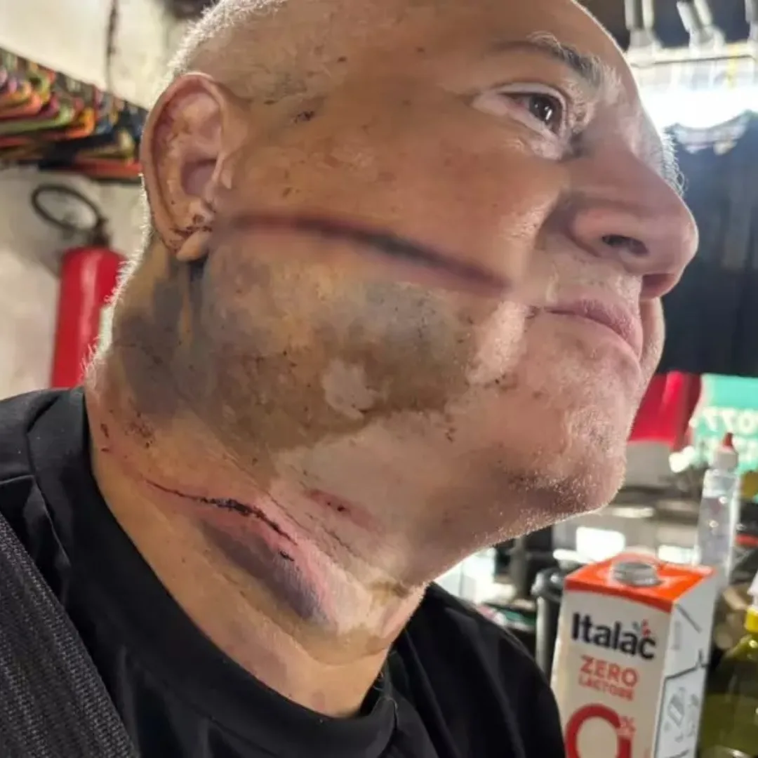 “Me livrei da morte 2 vezes”, diz comerciante ferido em tentativa de roubo