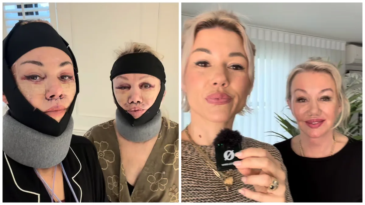 Mother, 69, and Daughter, 40, Get Matching Plastic Surgery