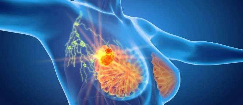 Cáncer de mama: cuándo hay que hacerse la mamografía, si tenés antecedentes familiares