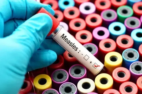 SA measles cases hit 3,462 as unvaccinated infants triple