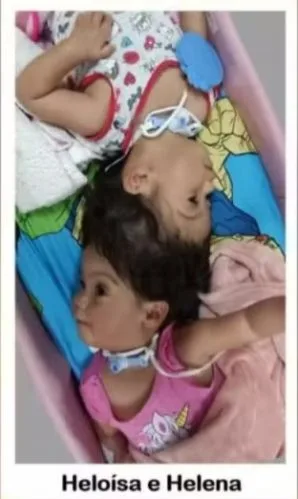 Cirurgião explica o que causou a morte das gêmeas que nasceram unidas pela cabeça em cirurgia final em SP Gêmeas que nasceram unidas pela cabeça morrem em cirurgia final de separação no interior de SP (Foto: Divulgação/Hospital das Clínicas de Ribeirão Preto)