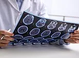 The remarkable link between MS and your stomach: As cases of multiple sclerosis surge, a breakthrough study reveals surprising new trigger of incurable illness - and simple steps you can take to reduce risks