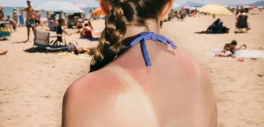 UV-Strahlung: Ist ein einziger Sonnenbrand schon gefährlich?