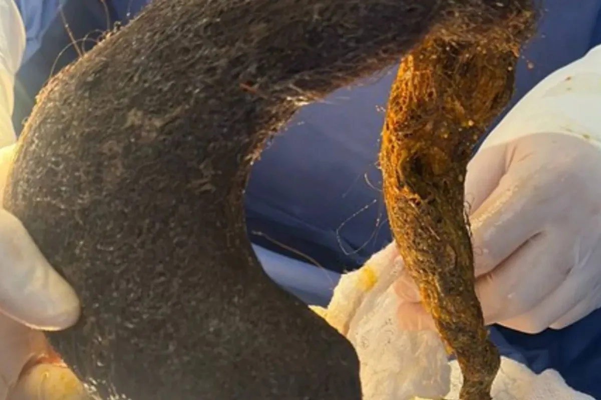 Síndrome de Rapunzel, el extraño trastorno que llevó a una mujer al quirófano para extraerle una bola de pelo que ocupaba el 90% de su estómago