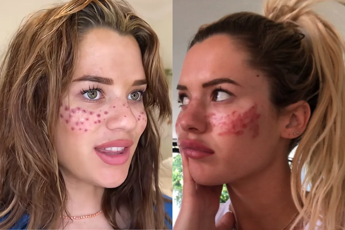 Influenciadora alerta sobre trend de beleza após parar no hospital