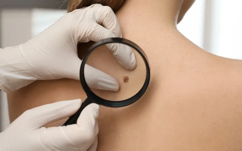 Cuba desarrolla tratamiento para el cáncer de piel