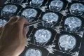 Una señal neuronal anómala podría estar detrás de algunos de los cambios asociados al Alzheimer