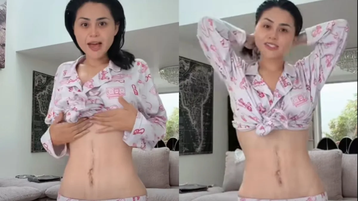 Gomita sorprende al mostrar en video las cicatrices que le quedaron tras cirugía que casi le cuesta la vida