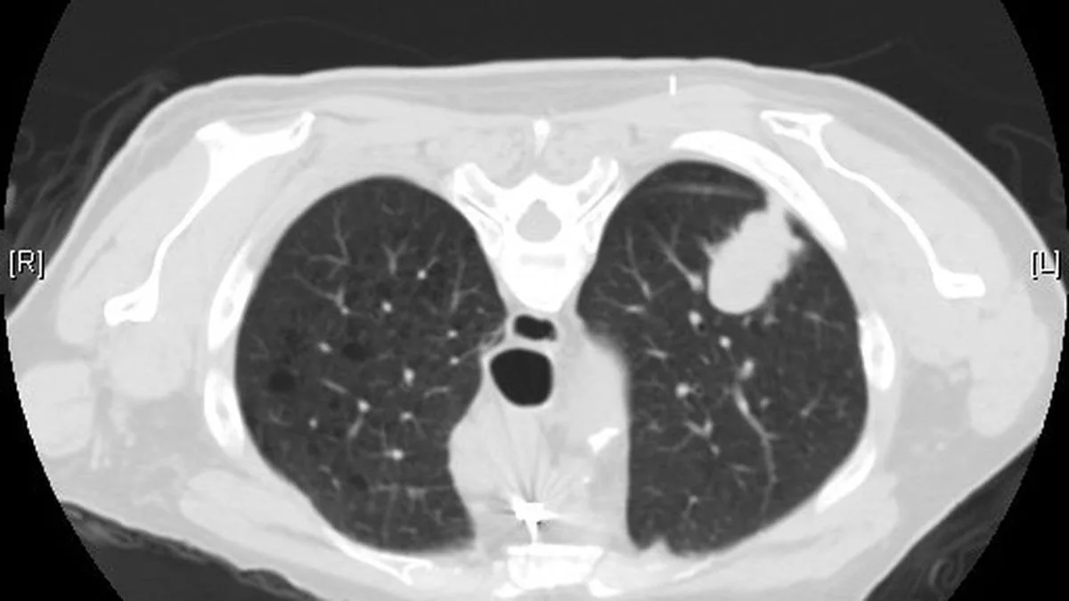 All you need to know about: lung adenocarcinoma