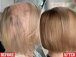 I suddenly developed bald patches and spent thousands of pounds on every available solution. I was about to buy a wig when I found this miracle supplement that gave me better hair than ever - and it costs less than $1