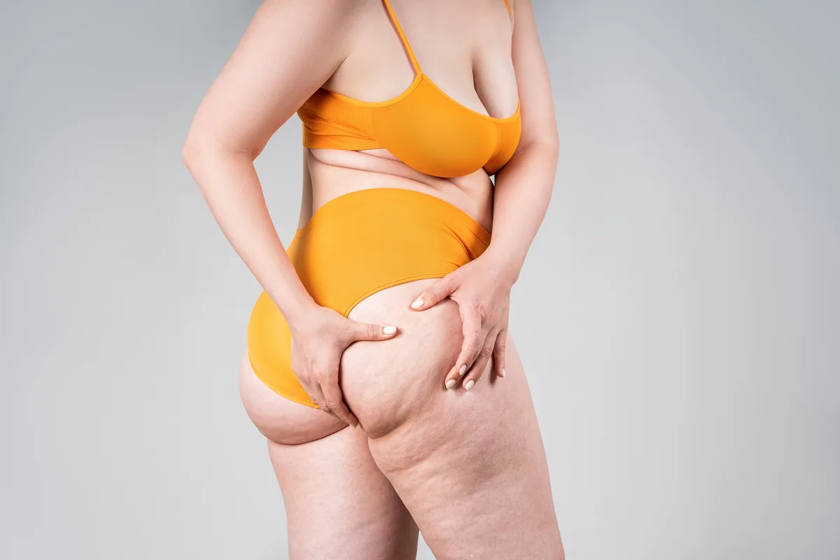 Celulite fica mais evidente na menopausa, mas há como minimizar o quadro