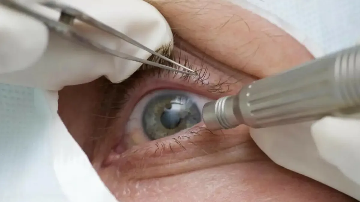 Nova cirurgia que trata glaucoma e catarata vai ser incorporada ao SUS