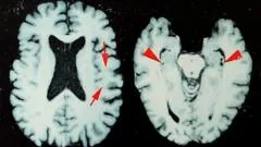 Brain disease in dead NFL players 'higher than previously shown'