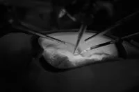 Cirurgia única para tratar glaucoma e catarata será oferecida pelo SUS