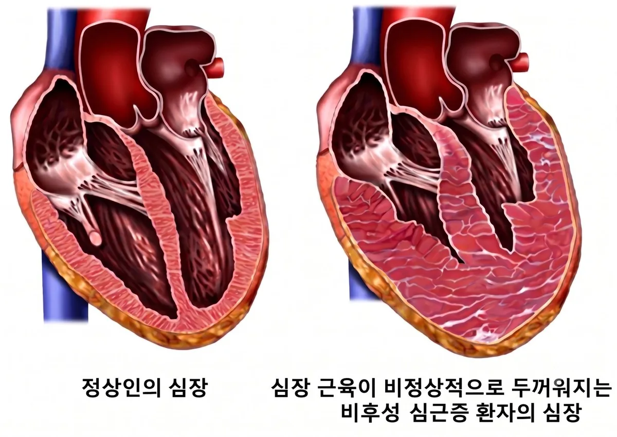 ‘이 질환’ 저위험군의 돌연사…원인은 왼쪽 심장