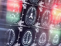 Eingriff am Hals: Alzheimer operieren? Was hinter der umstrittenen Methode steckt