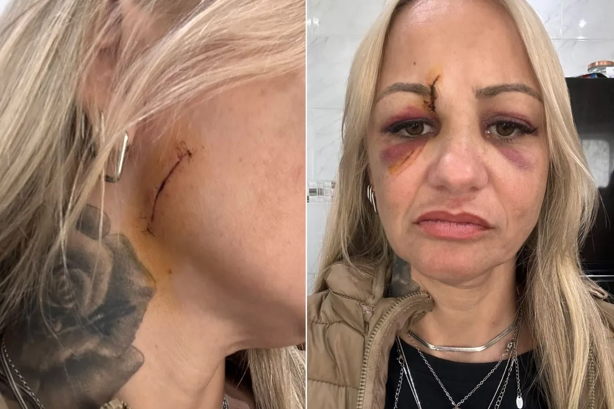 Cabeleireira leva pontos no rosto após ser agredida com taça de vidro na saída de bar no litoral de SP