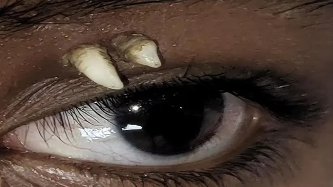 Teenage boy from India records first case of an ectopic tooth growing out of an eye