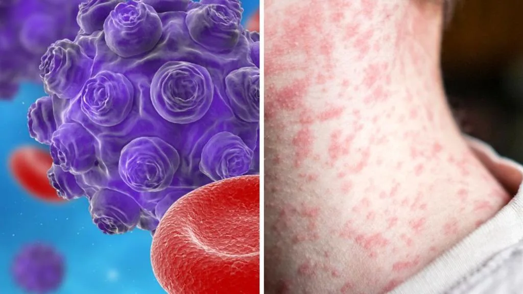 Landmark study finds 1.7 million Australians may be vulnerable to measles as overseas-linked cases rise