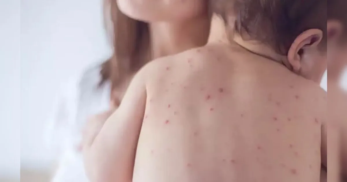 Bebê com vacinação incompleta é 32º caso de sarampo no estado de SP