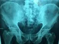 Una IA puede predecir quién sufrirá una fractura de cadera y detectar hasta siete veces más personas en riesgo