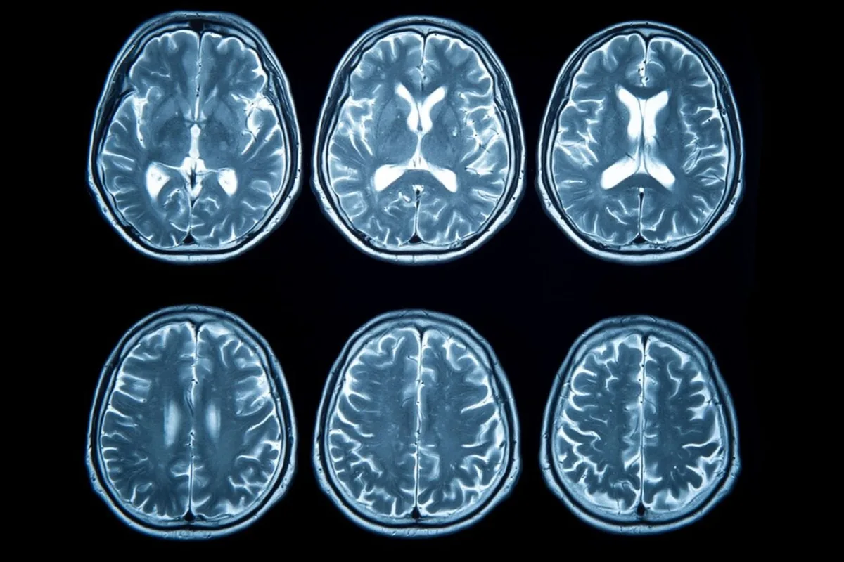 Stroke Rates in Younger Americans Have Nearly Doubled Since the 90s—and Scientists Can’t Fully Explain It