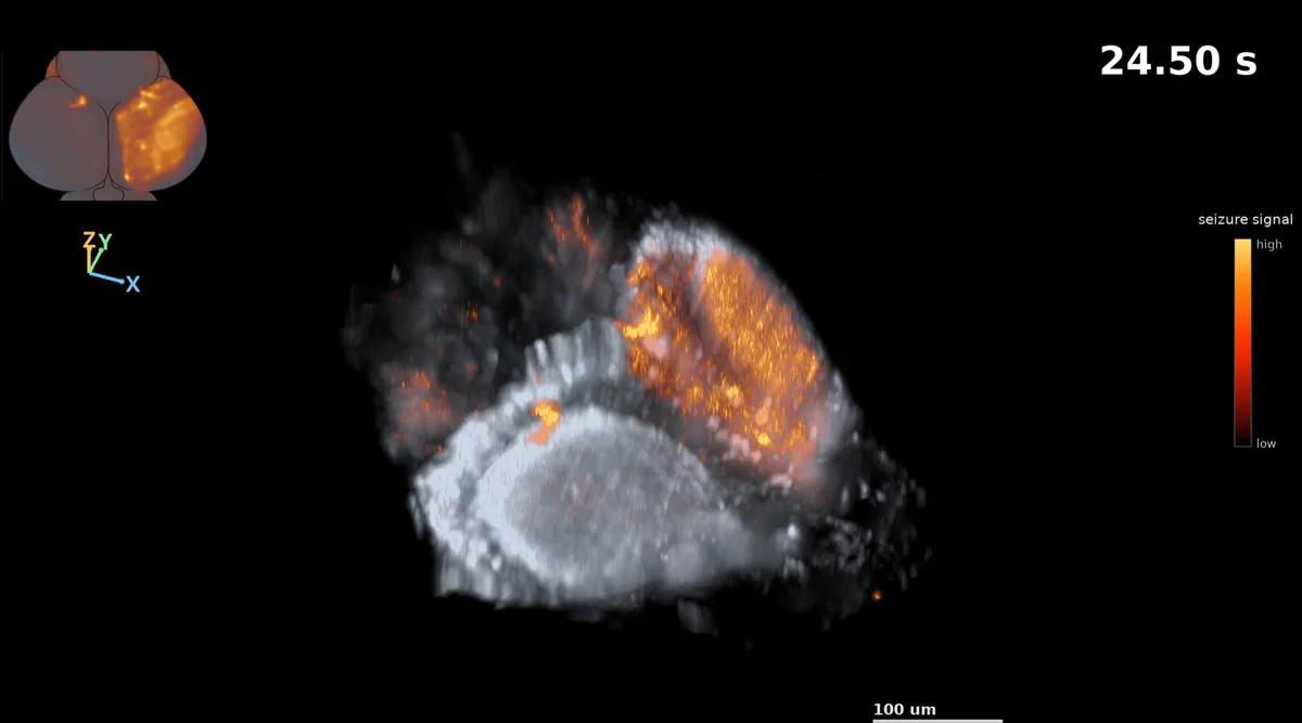 Cientistas capturam uma convulsão em tempo real pela 1ª vez; veja vídeo