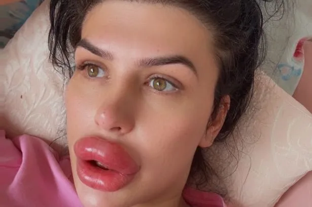 Woman injects her own lip fillers at home after doctors refused
