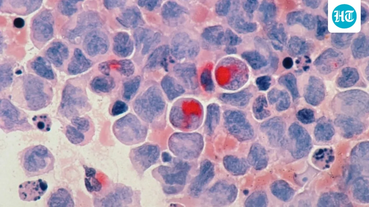 Pancreatic cancer drug Daraxonrasib gets approval from FDA: All you need to know