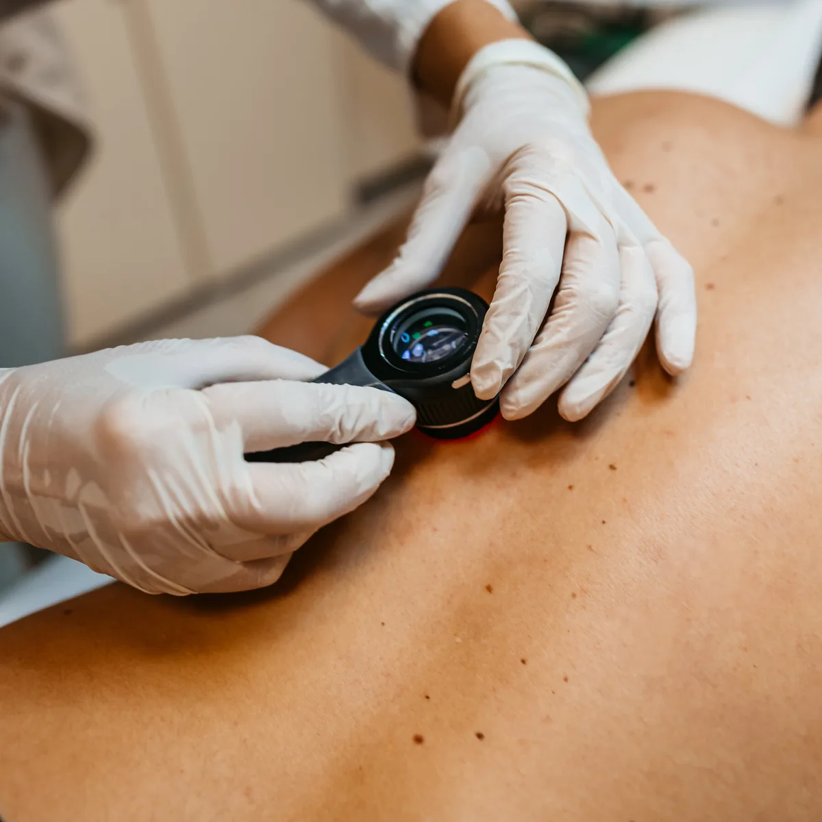 What to Know About Melanoma