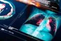 Identifican una vía para frenar la fibrosis pulmonar