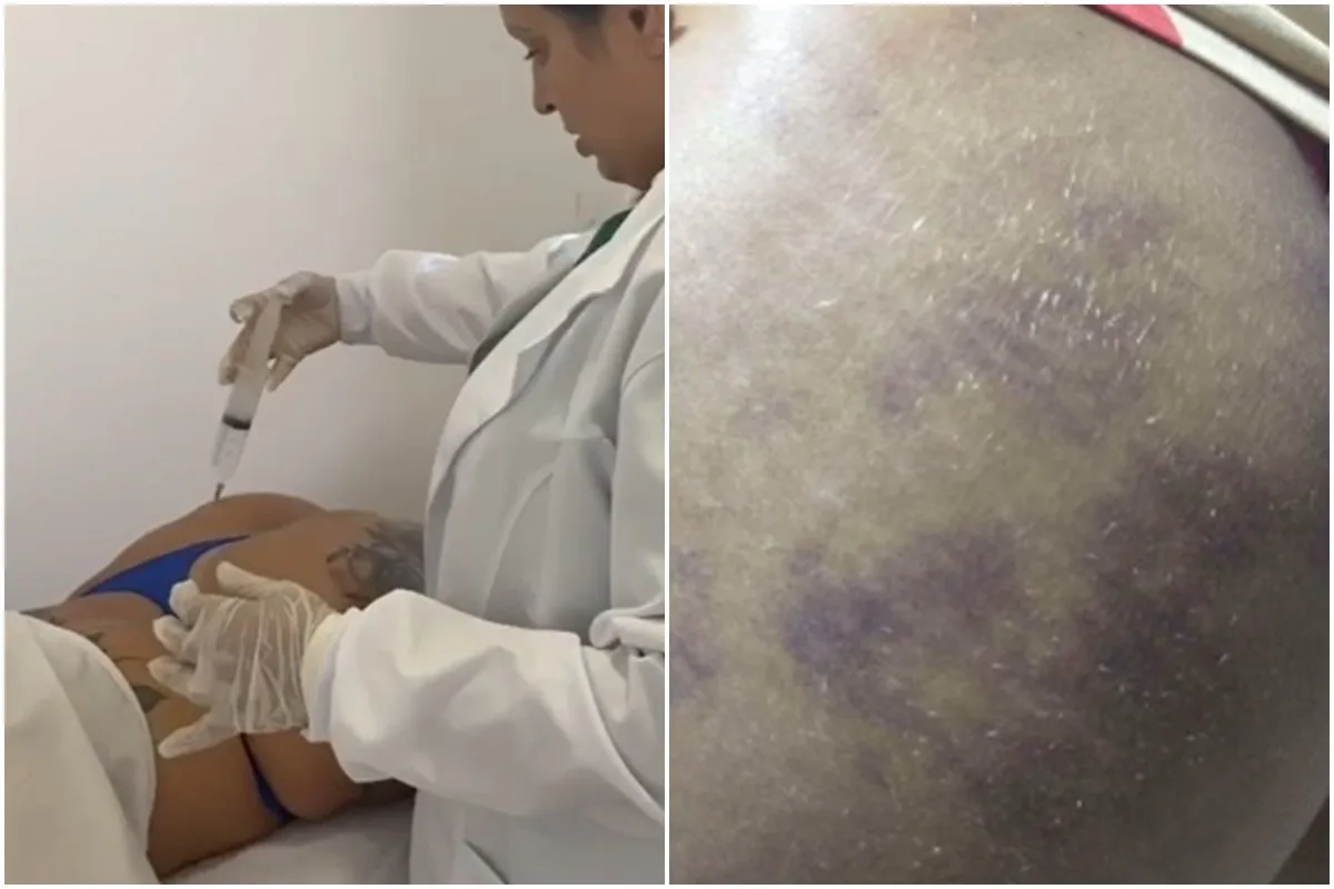 ‘Nunca disse que sou médica’, afirma suspeita presa por realizar procedimentos estéticos irregulares, na PB