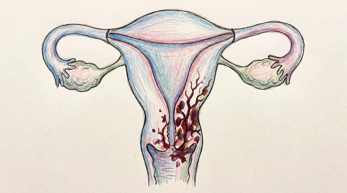 “Misiles teledirigidos”: la ciencia estudia nuevos métodos para luchar contra el cáncer de cuello uterino