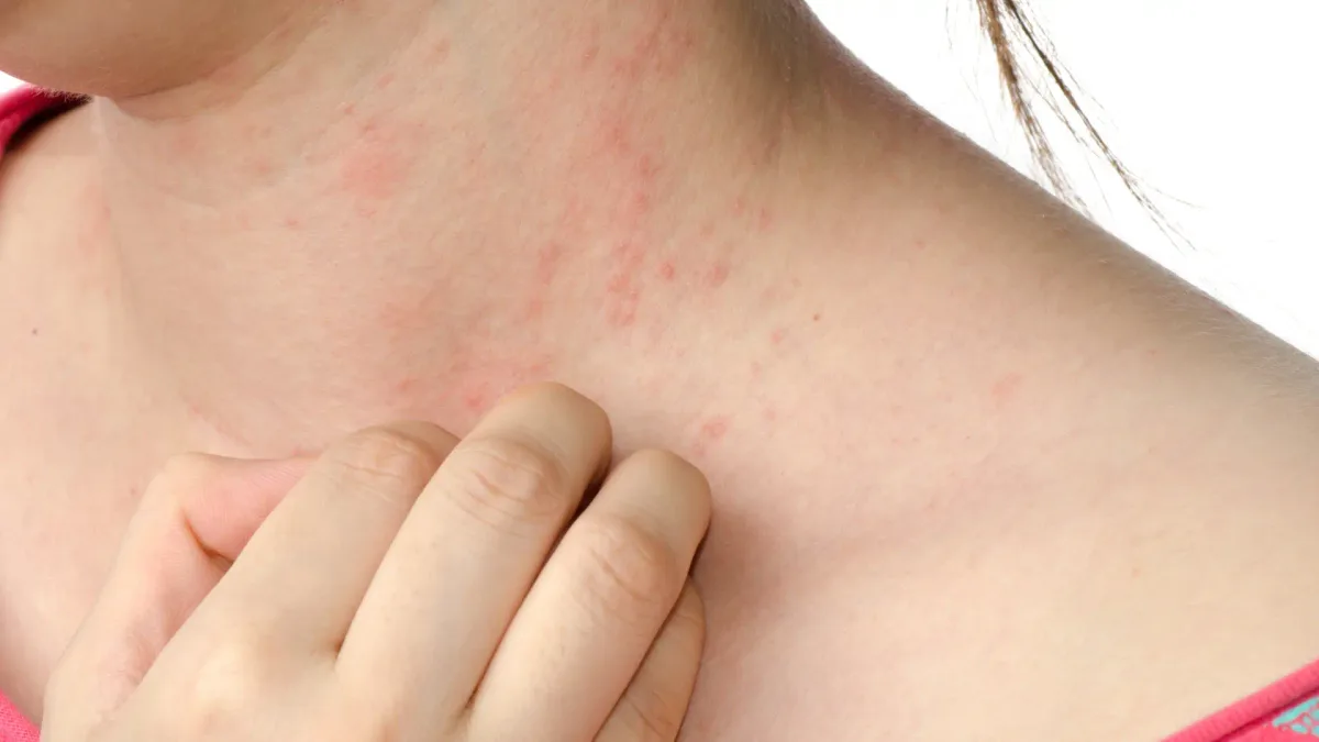 Estos son los síntomas de la sarna: cómo prevenir esta infección dermatológica altamente contagiosa