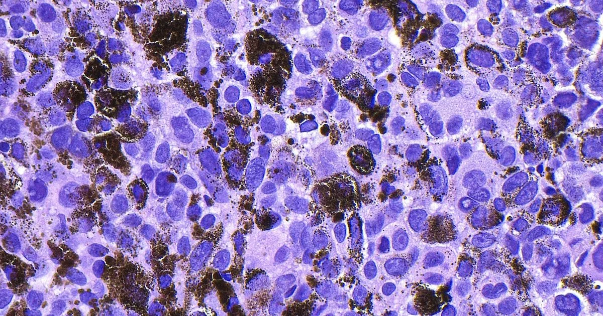 Des résultats « prometteurs pour le domaine du mélanome et du cancer en général » : pourquoi le vaccin n’a jamais semblé autant à portée de main