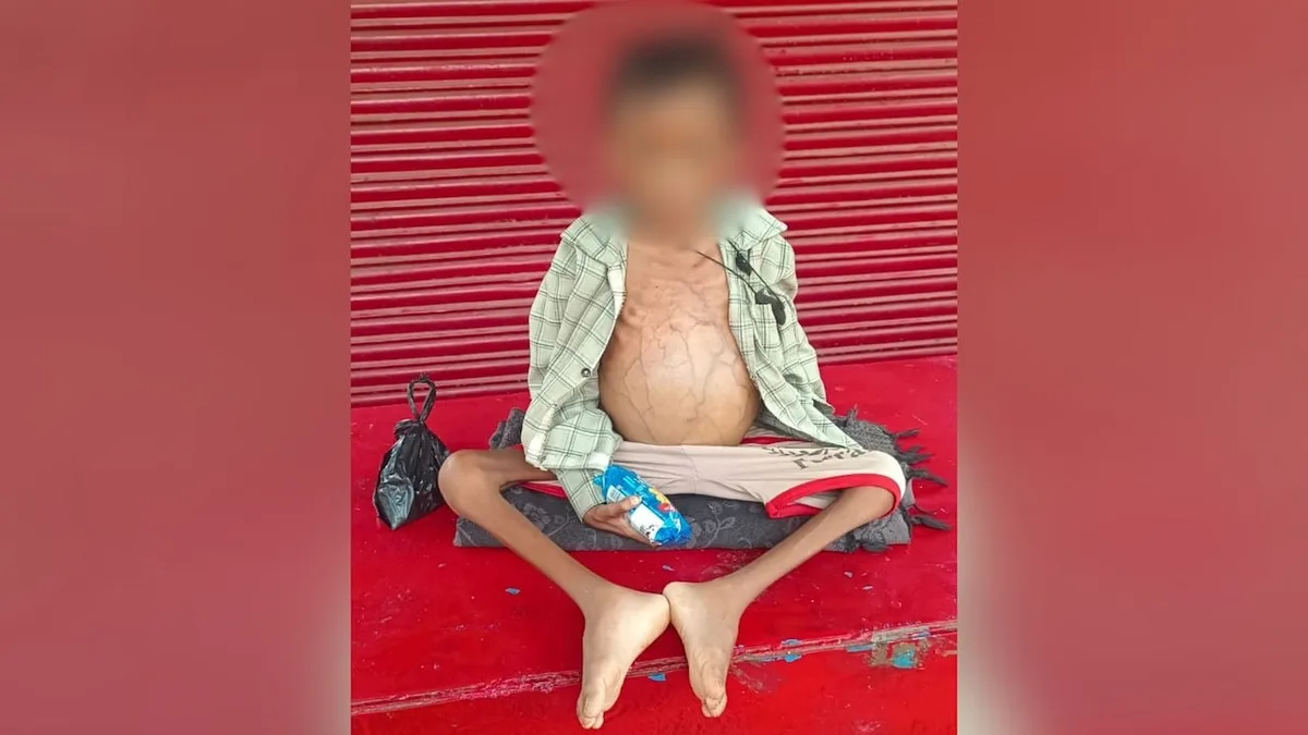After 7-Year-Old Child's Death In Madhya Pradesh, Family's Malnutrition Charge