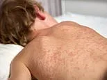 Measles outbreaks in multiple states potentially exposes thousands... as US records first deaths this year