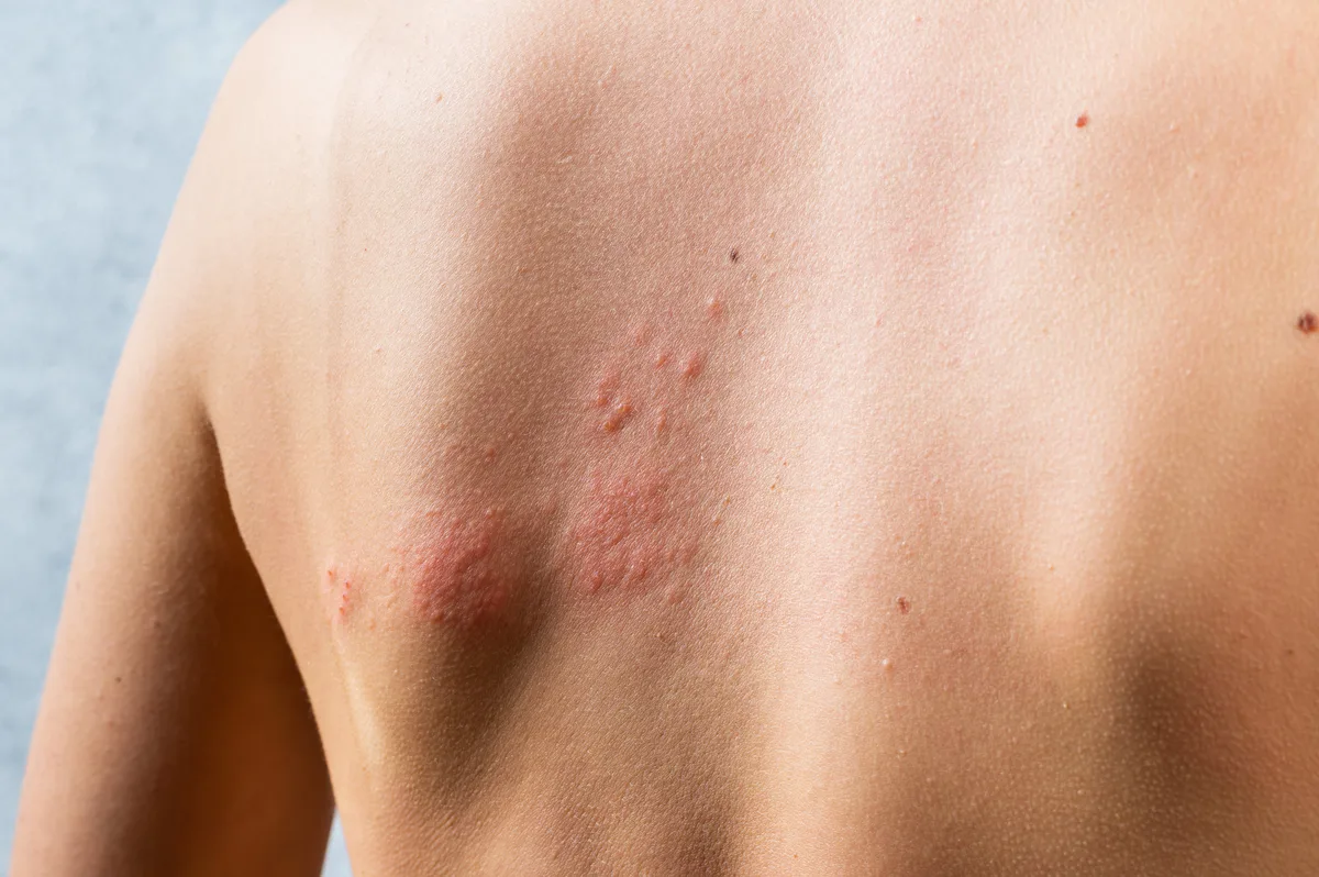 Herpes zóster: cuáles son los síntomas iniciales que la mayoría de los pacientes no reconocen