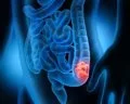 Desarrollan un modelo de 'cáncer en un chip' para personalizar tratamientos del cáncer de colon