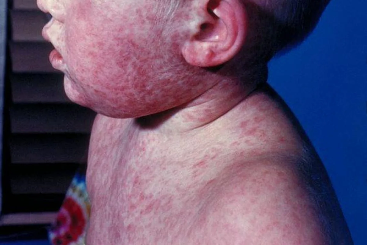 Pennsylvania reports first measles deaths in 35 years