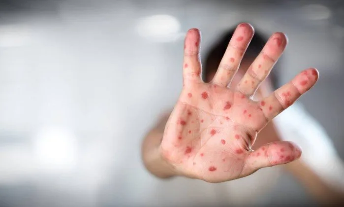 Casos de Sarampo no Brasil: entenda os sintomas, riscos e como se proteger