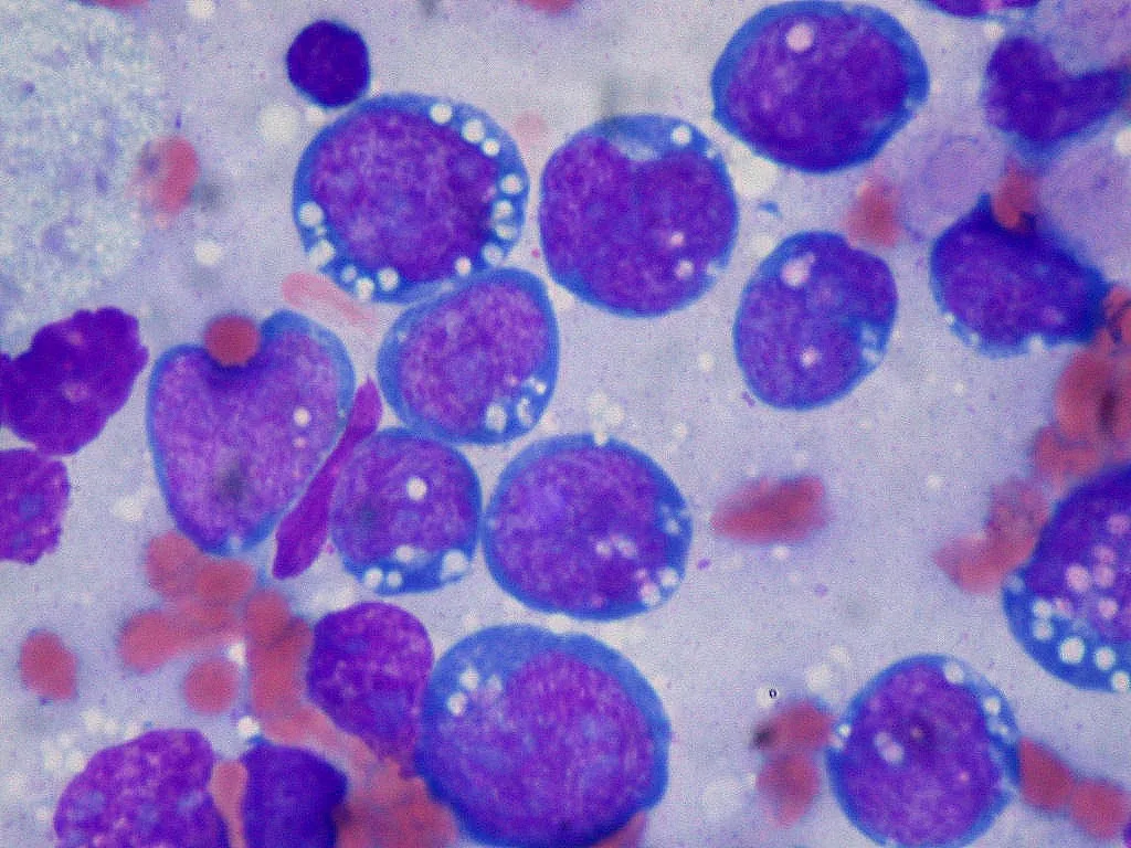 Estudo identifica como o linfoma “desliga” células de defesa do organismo