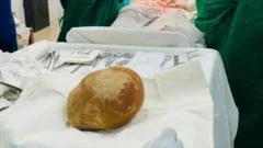 Doctors remove record-size bladder stone