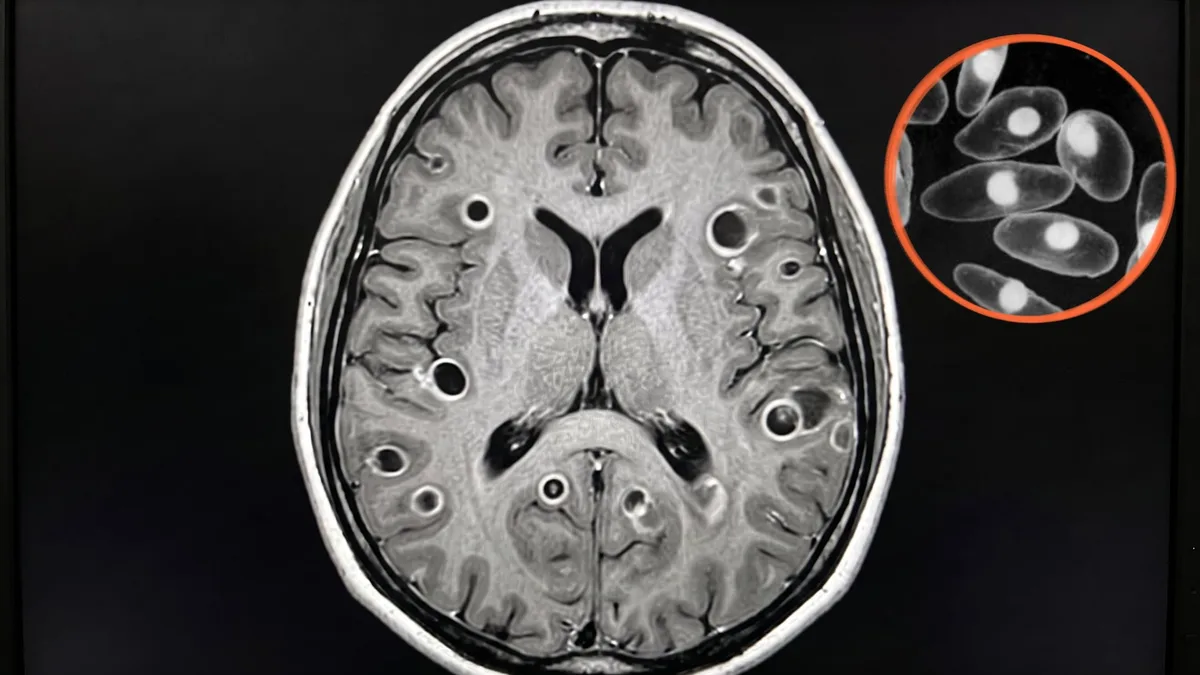 Gusanos en el cerebro: uno de cada tres humanos carga un parásito