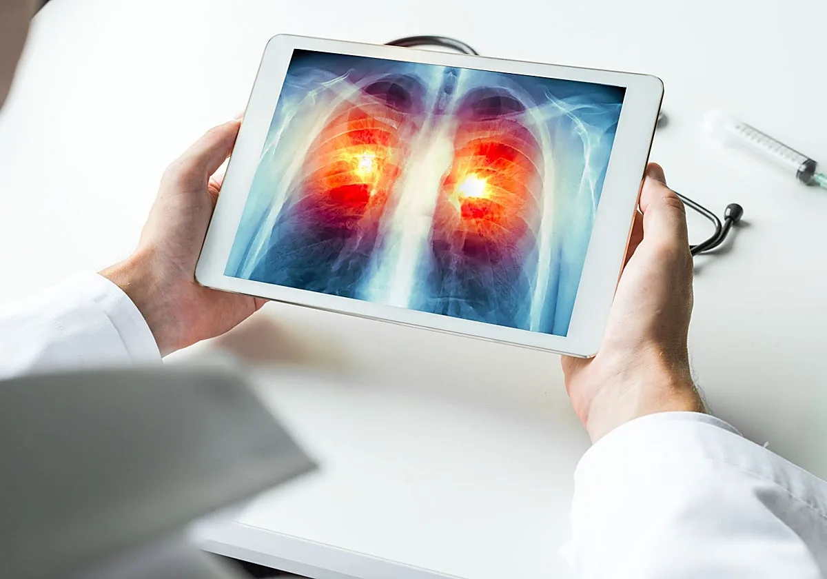 ¿Qué es un nódulo pulmonar? La lesión por la que operan al Papa y es frecuente entre fumadores y exfumadores