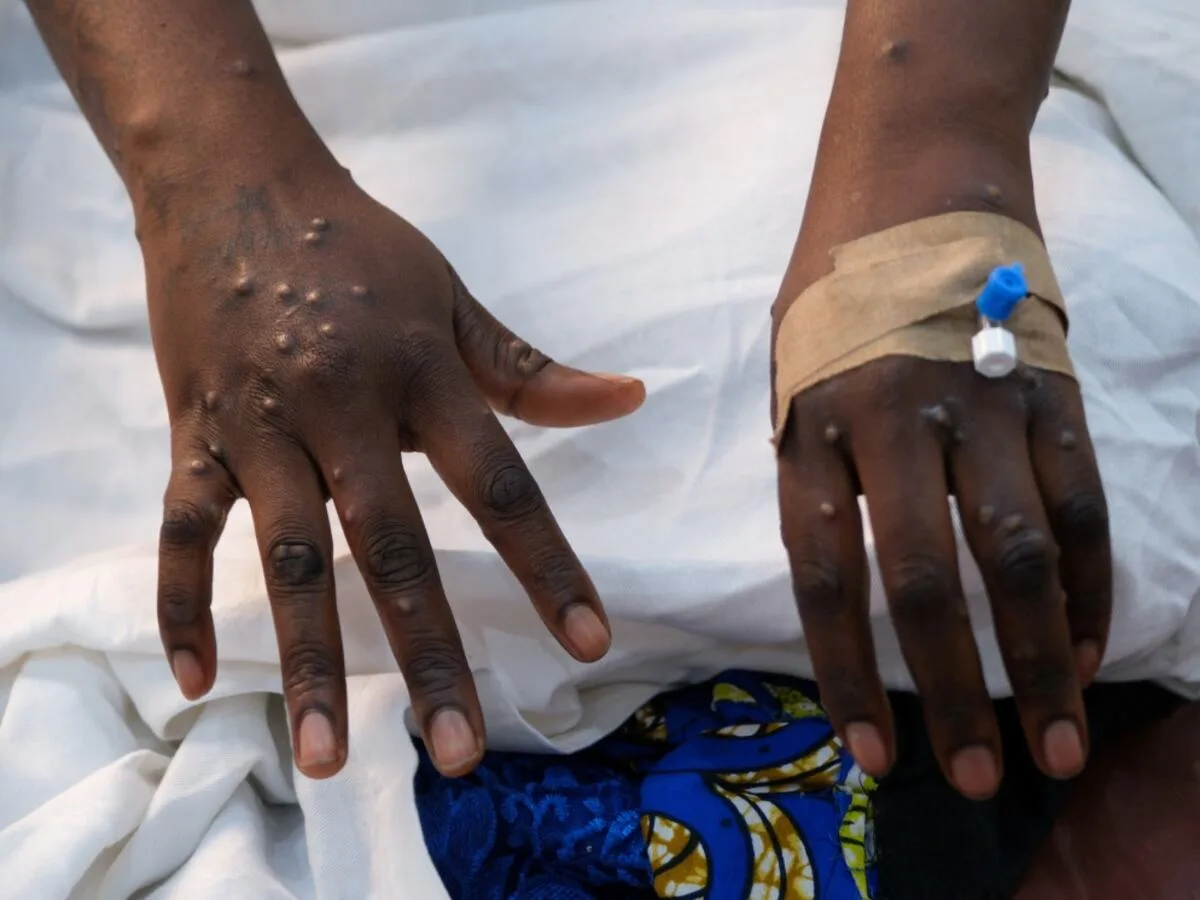 Surge in Mpox cases sparks call for public vigilance