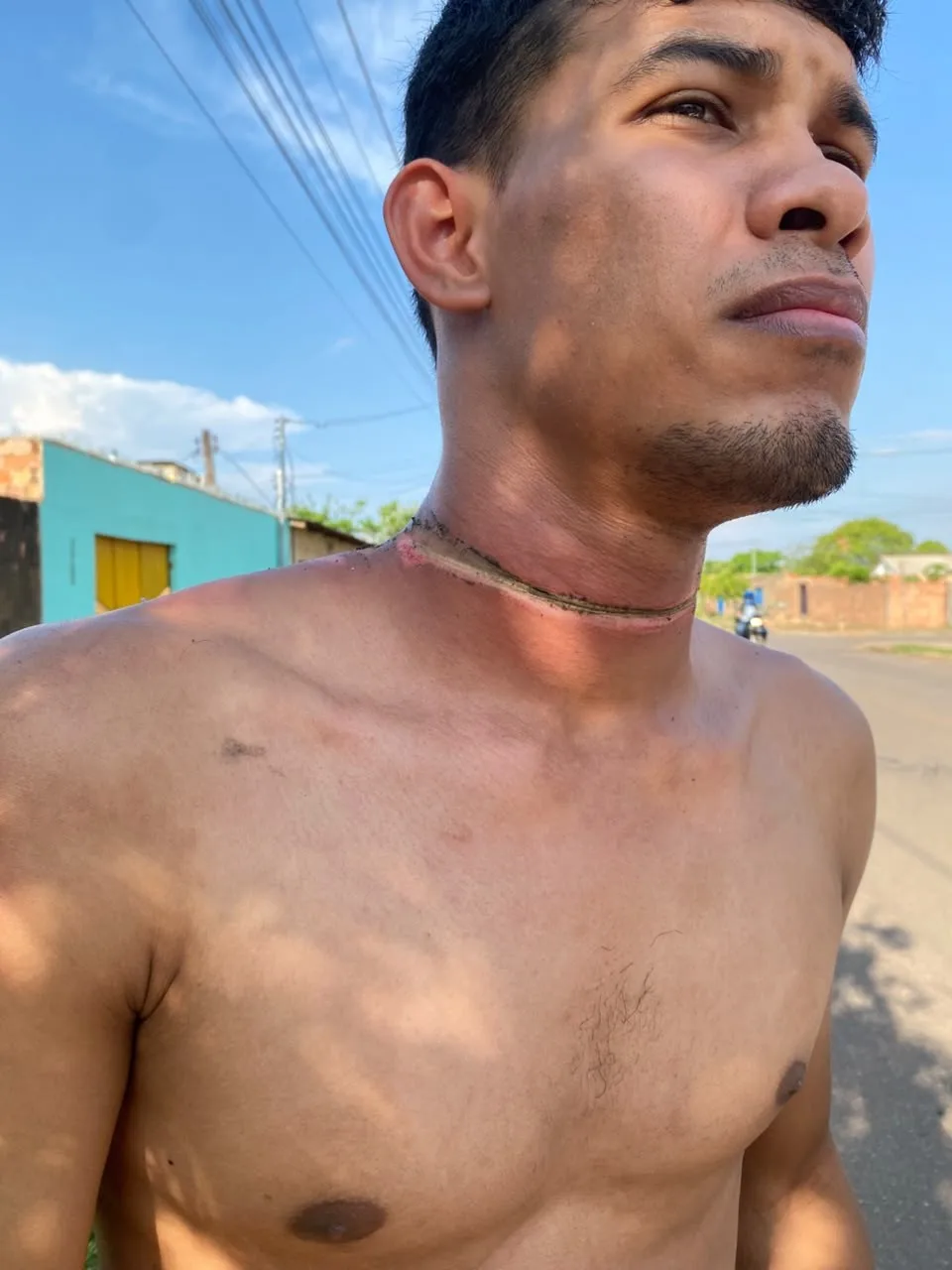 Homem fica ferido após fiação enroscar em seu pescoço enquanto andava de moto em Porto Velho
