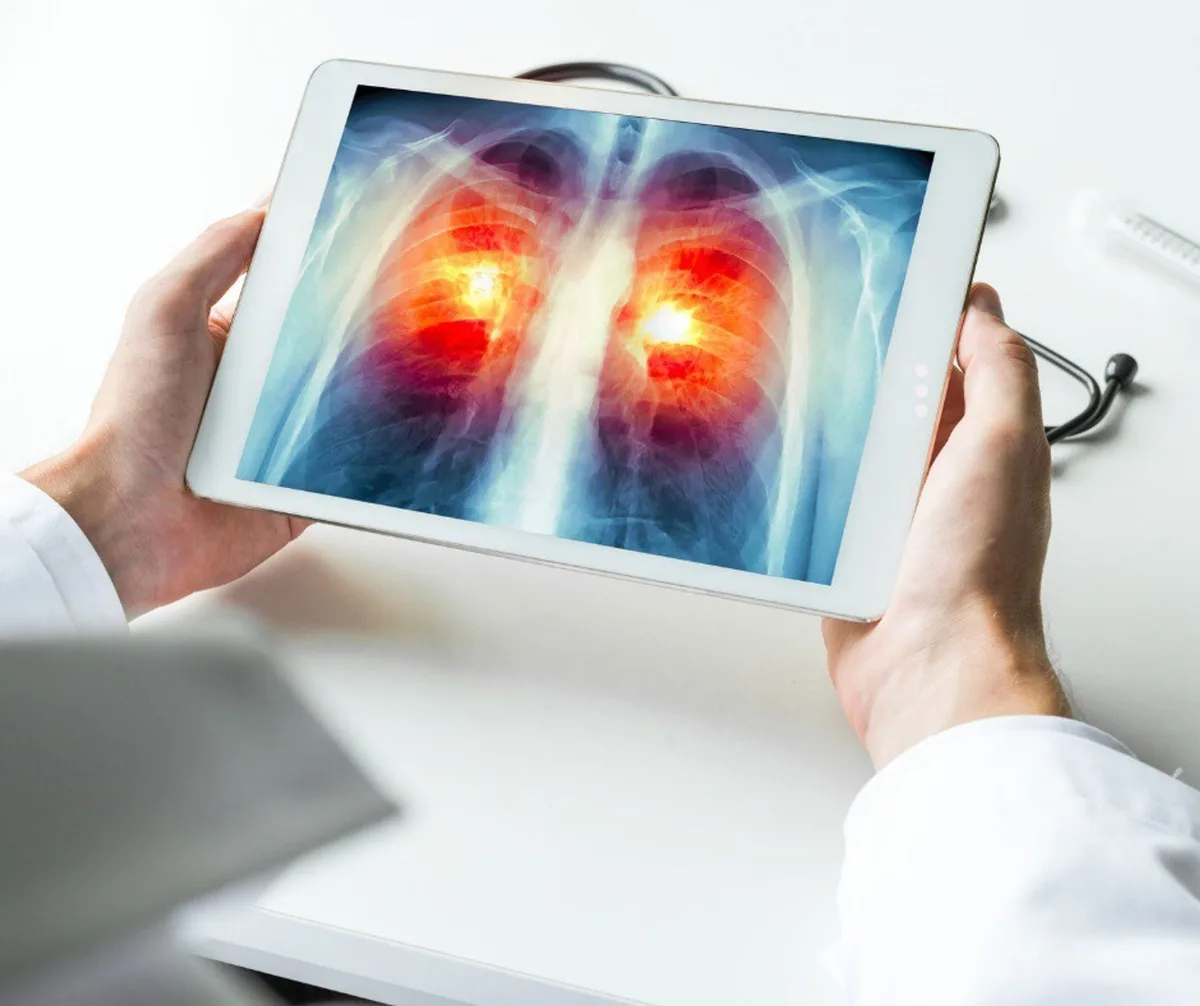 Cáncer de pulmón: cuáles son sus síntomas, factores de riesgo y cómo prevenirlo