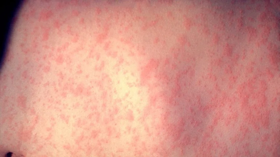 New York launches tracker as measles cases hit 57