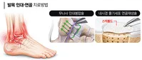 반복되는 염좌를 무시하면 안 되는 이유
